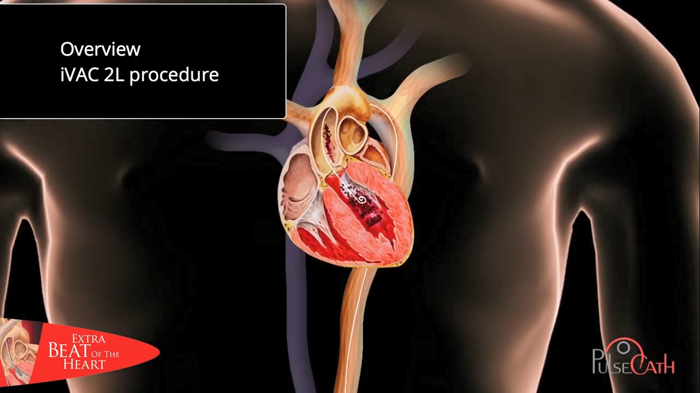 pulsecath - iVAC 2L